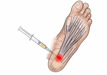 Cortisone Injection for foot pain