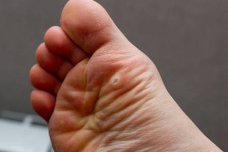 Wart Treatment on your Feet